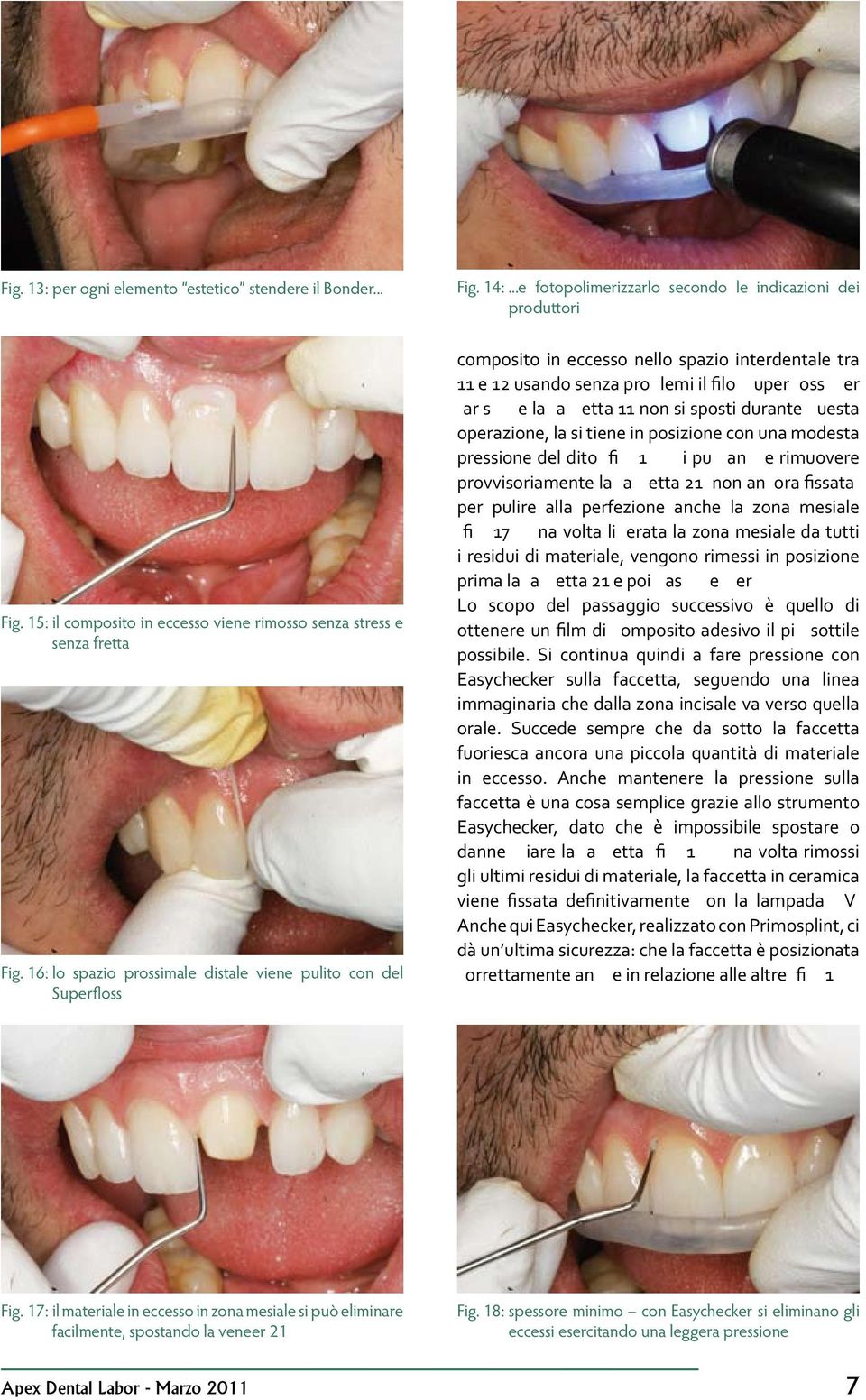 16: lo spazio prossimale distale viene pulito con del Superfloss composito in eccesso nello spazio interdentale tra 11 e 12 usando senza problemi il filo Superfloss.