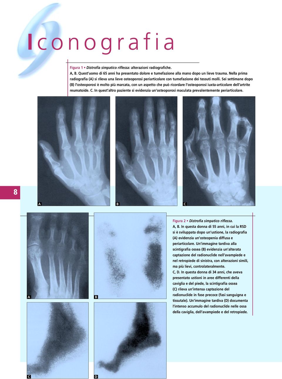 Sei settimane dopo () l osteoporosi è molto più marcata, con un aspetto che può ricordare l osteoporosi iuxta-articolare dell artrite reumatoide.