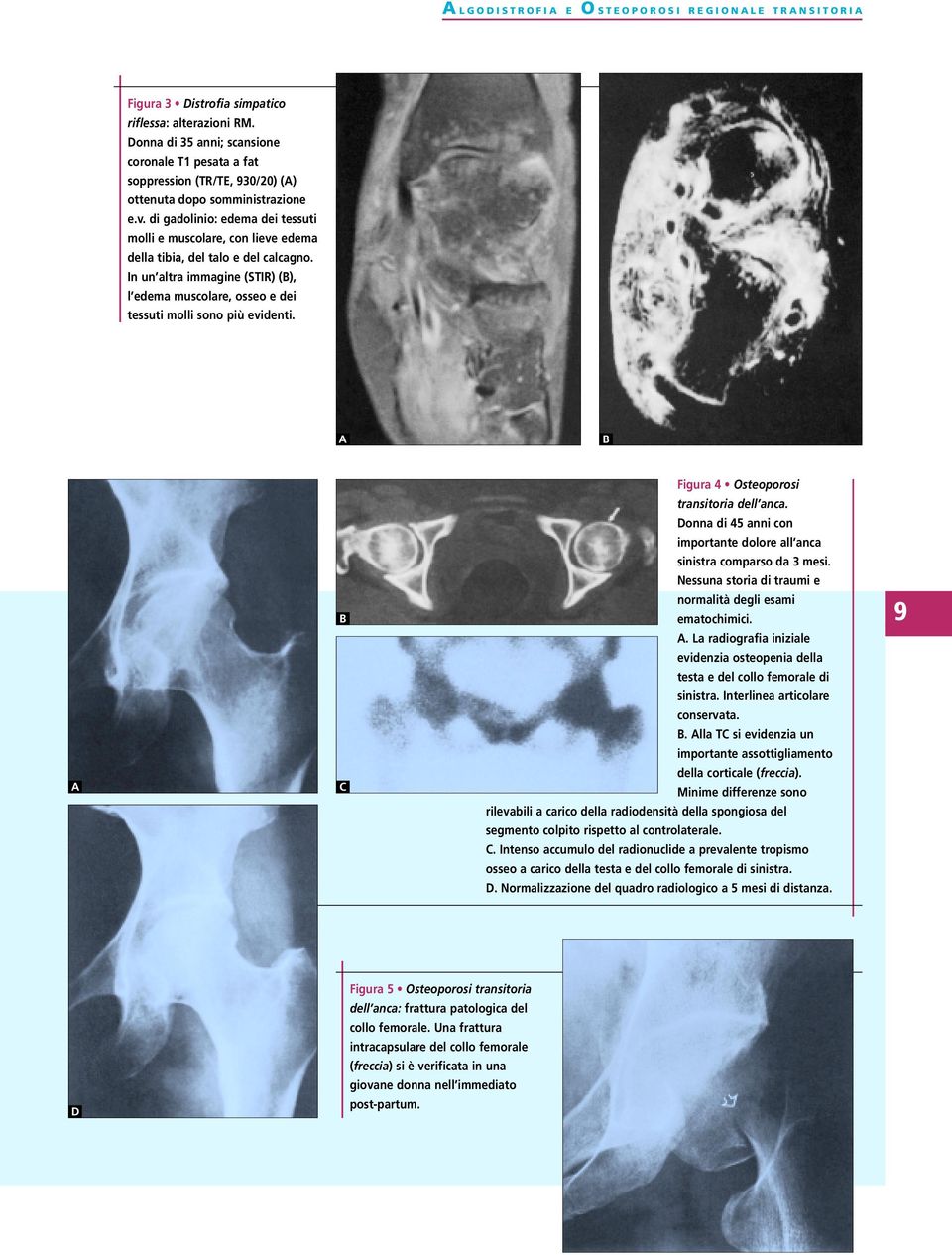 di gadolinio: edema dei tessuti molli e muscolare, con lieve edema della tibia, del talo e del calcagno. In un altra immagine (STIR) (), l edema muscolare, osseo e dei tessuti molli sono più evidenti.