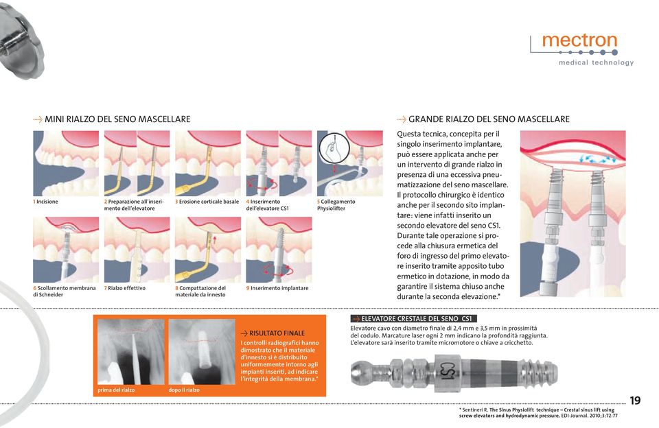 implantare, può essere applicata anche per un intervento di grande rialzo in presenza di una eccessiva pneumatizzazione del seno mascellare.