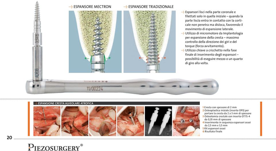 Û u tilizzo di micromotore da implantologia per espansione della cresta massimo controllo della direzione dei giri e del torque (forza avvitamento).