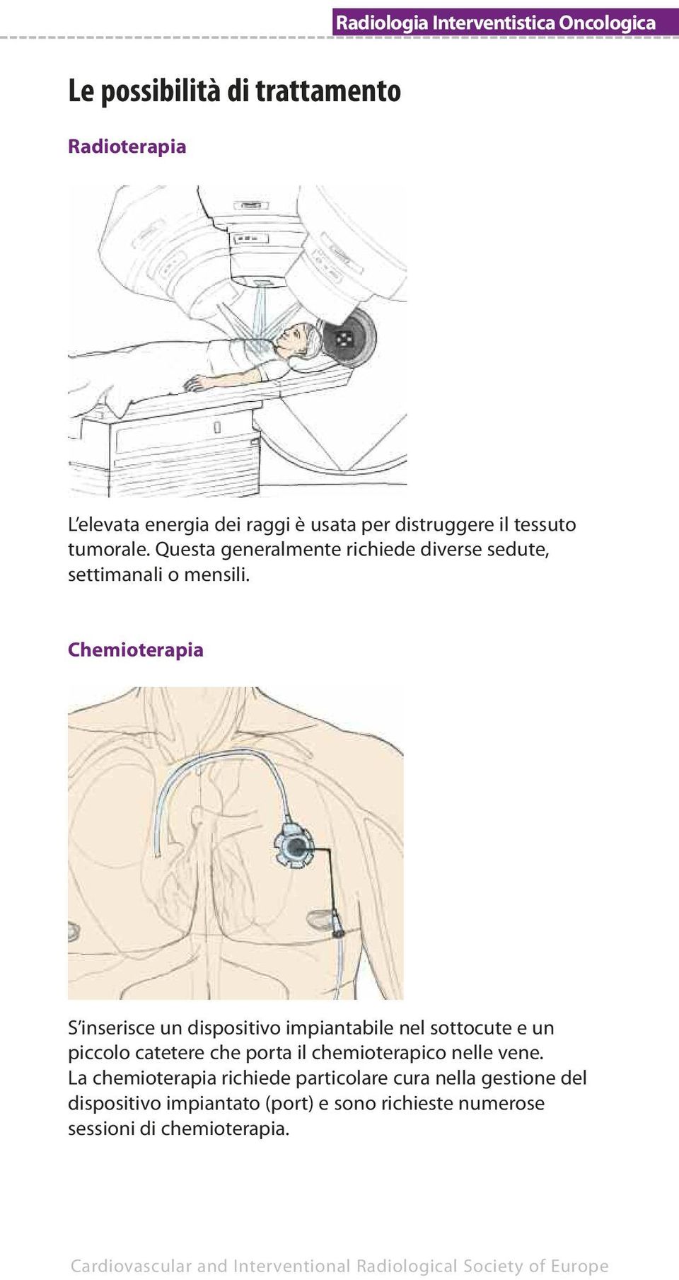 Chemioterapia S inserisce un dispositivo impiantabile nel sottocute e un piccolo catetere che porta il chemioterapico nelle vene.