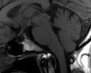 Protocollo RM fossa cranica posteriore Ottenuta la sequenza T1w sagittale, su questa andremo a posizionare le successive sequenze assiali e coronali, orientandole secondo i piani di acquisizioni