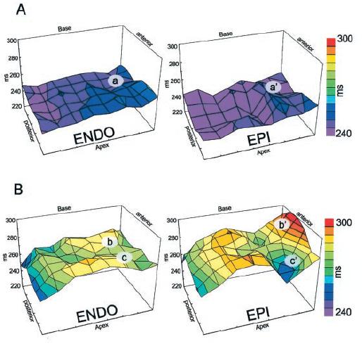 Elettrogenesi del pattern ECG e meccanismo delle aritmie Il sopraslivellamento ST in V1- V3 è provocato da un gradiente trasmurale di voltaggio durante la fase di ripolarizzazione.