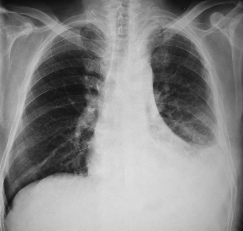 MESOTELIOMA QUADRO RX N.B.