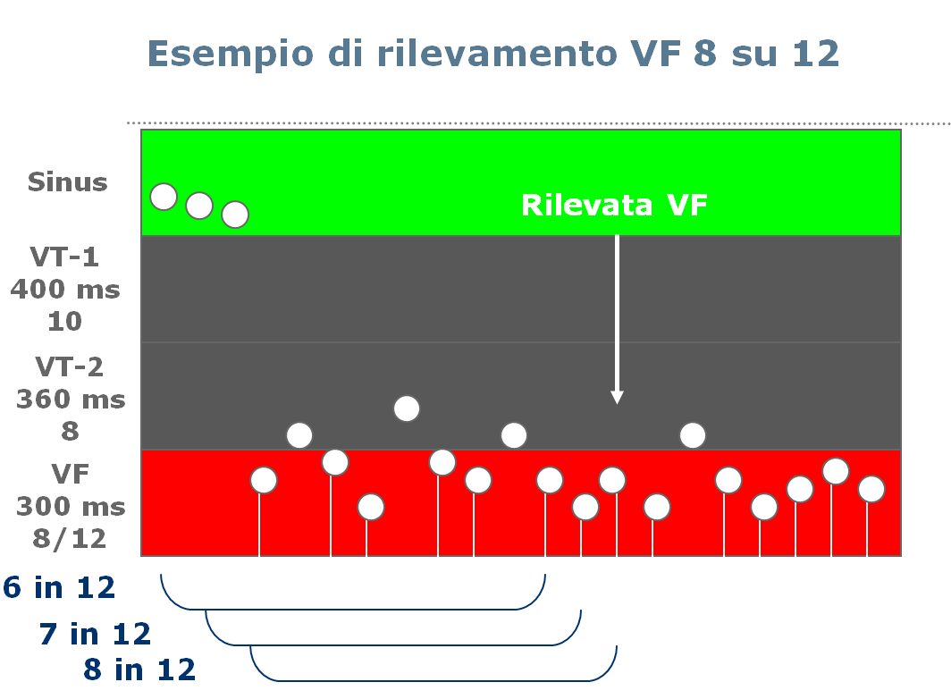 Esempio di shock, in rosso, erogato su episodio di VF.