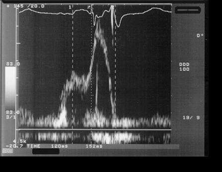 Multi point Pacing P4 M3 M2 10 LV Configurations Ottimizzazione del ritardo atrio-ventricolare e offset del ventricolo sinistro: Se l obiettivo è quello di massimizzare la percentuale di stimolazione