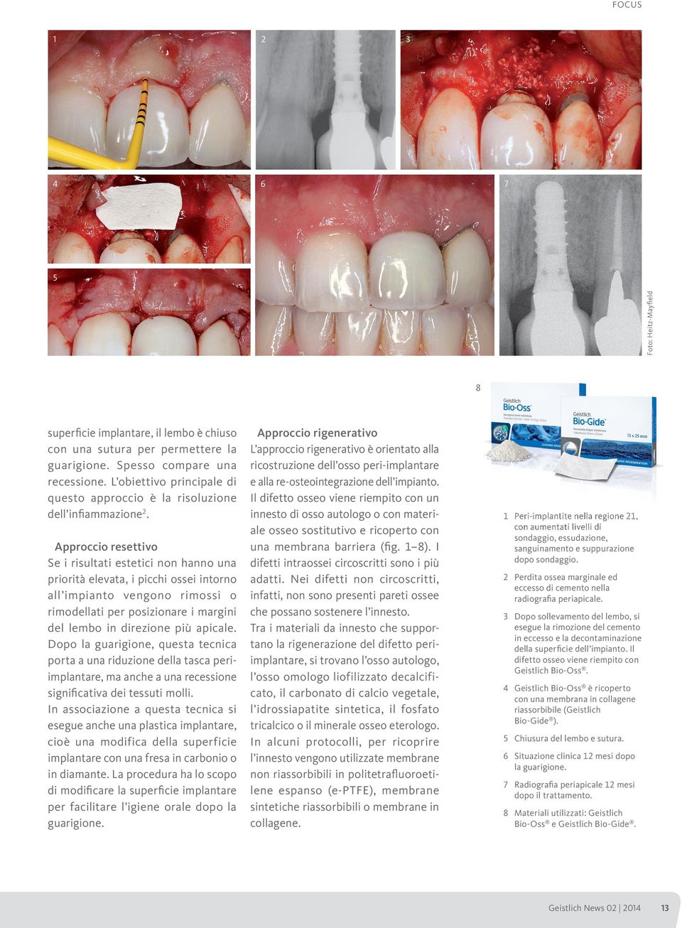 Approccio resettivo Se i risultati estetici non hanno una priorità elevata, i picchi ossei intorno all impianto vengono rimossi o rimodellati per posizionare i margini del lembo in direzione più