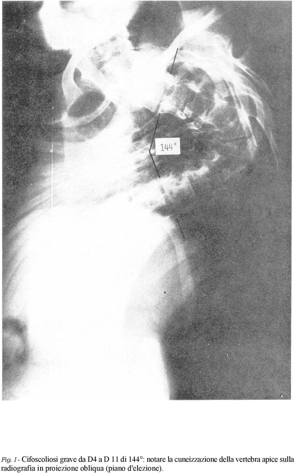 della vertebra apice sulla radiografia