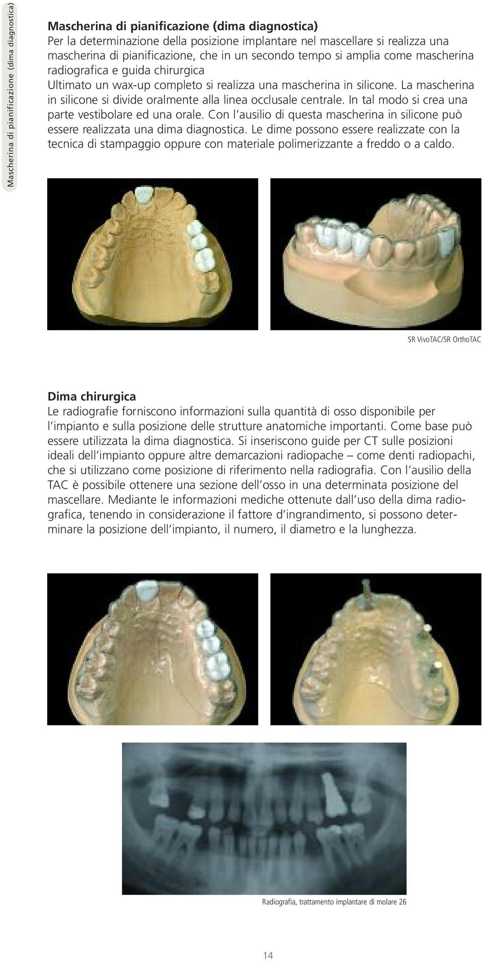 La mascherina in silicone si divide oralmente alla linea occlusale centrale. In tal modo si crea una parte vestibolare ed una orale.