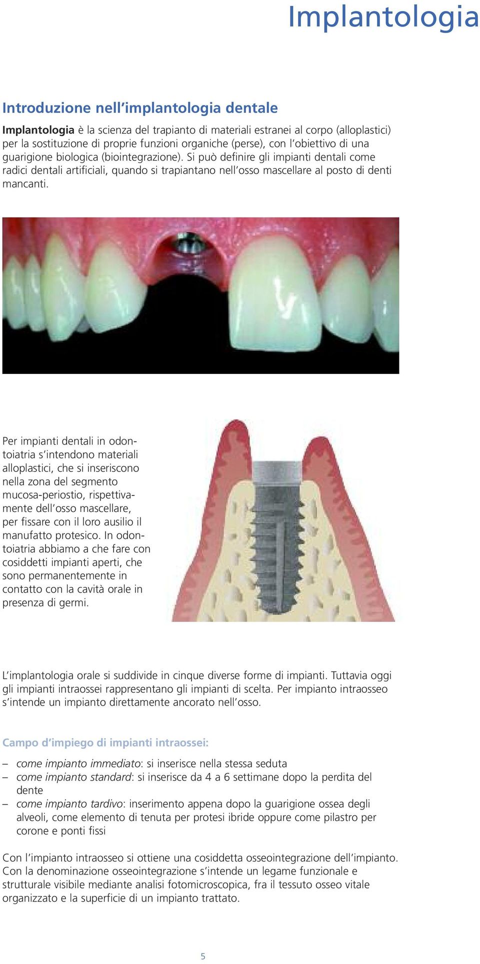 Si può definire gli impianti dentali come radici dentali artificiali, quando si trapiantano nell osso mascellare al posto di denti mancanti.