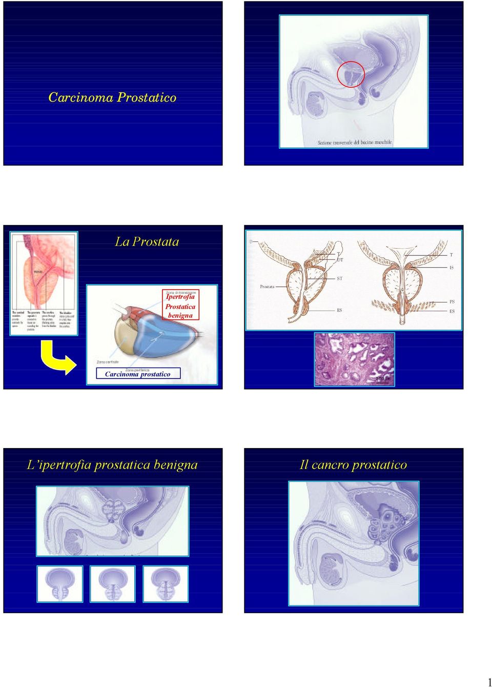 Prostatica benigna L