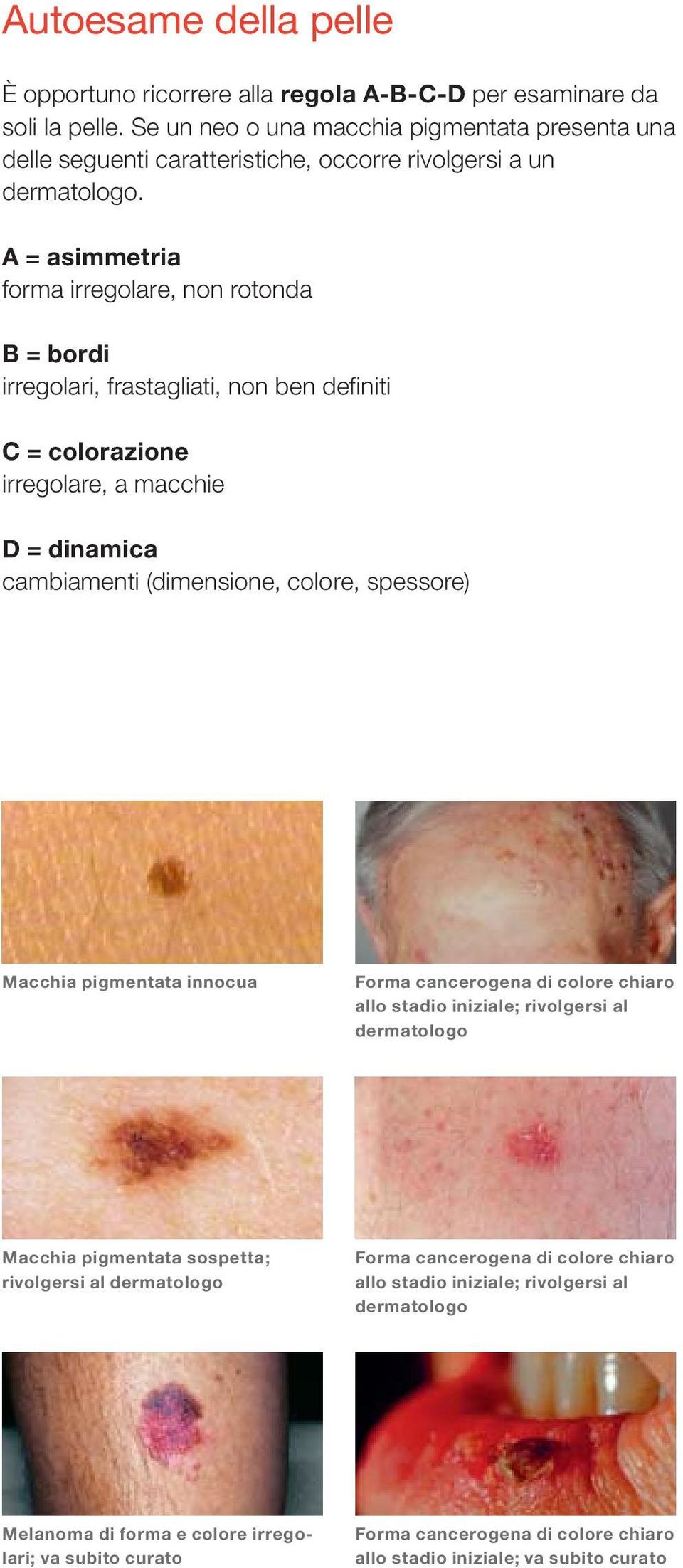 A = asimmetria forma irregolare, non rotonda B = bordi irregolari, frastagliati, non ben definiti C = colorazione irregolare, a macchie D = dinamica cambiamenti (dimensione, colore, spessore)