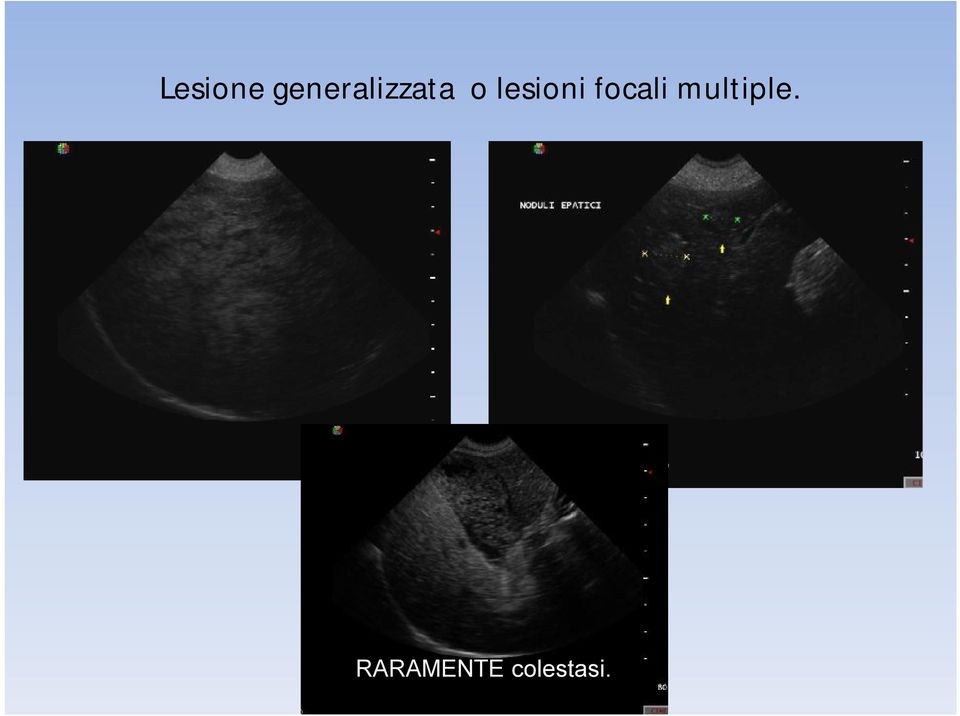 lesioni focali