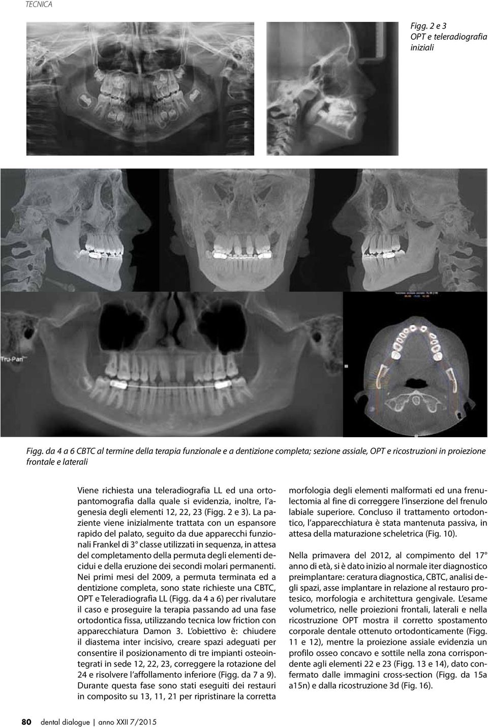 ortopantomografia dalla quale si evidenzia, inoltre, l agenesia degli elementi 12, 22, 23 (Figg. 2 e 3).