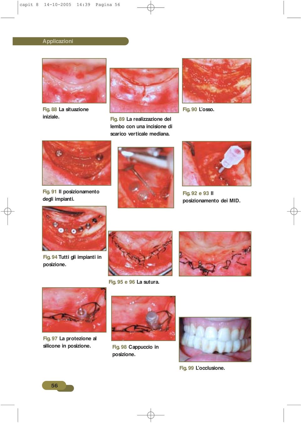 89 La realizzazione del lembo con una incisione di scarico verticale mediana. Fig.