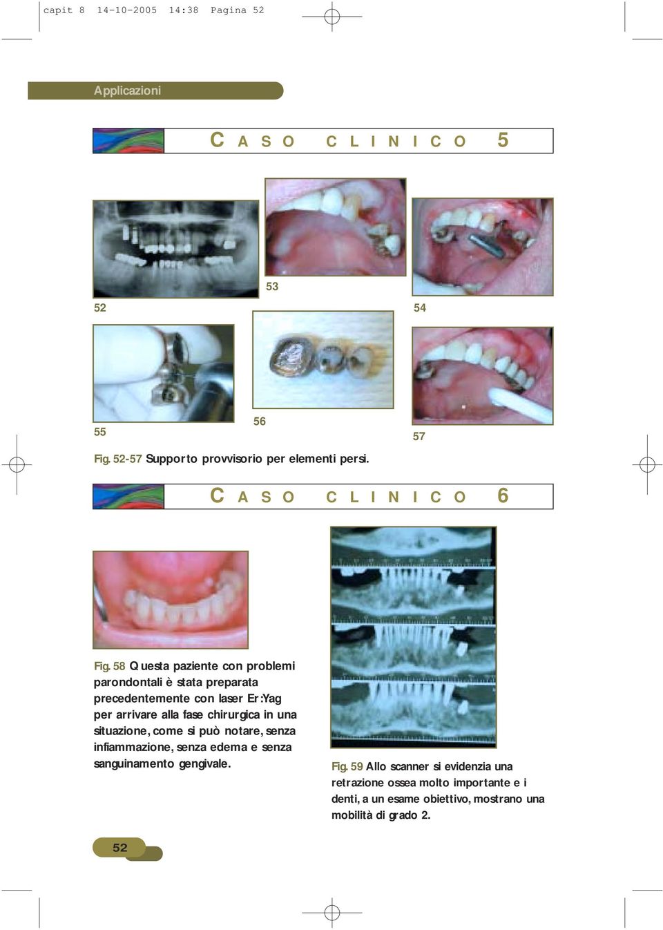 58 Questa paziente con problemi parondontali è stata preparata precedentemente con laser Er:Yag per arrivare alla fase chirurgica in