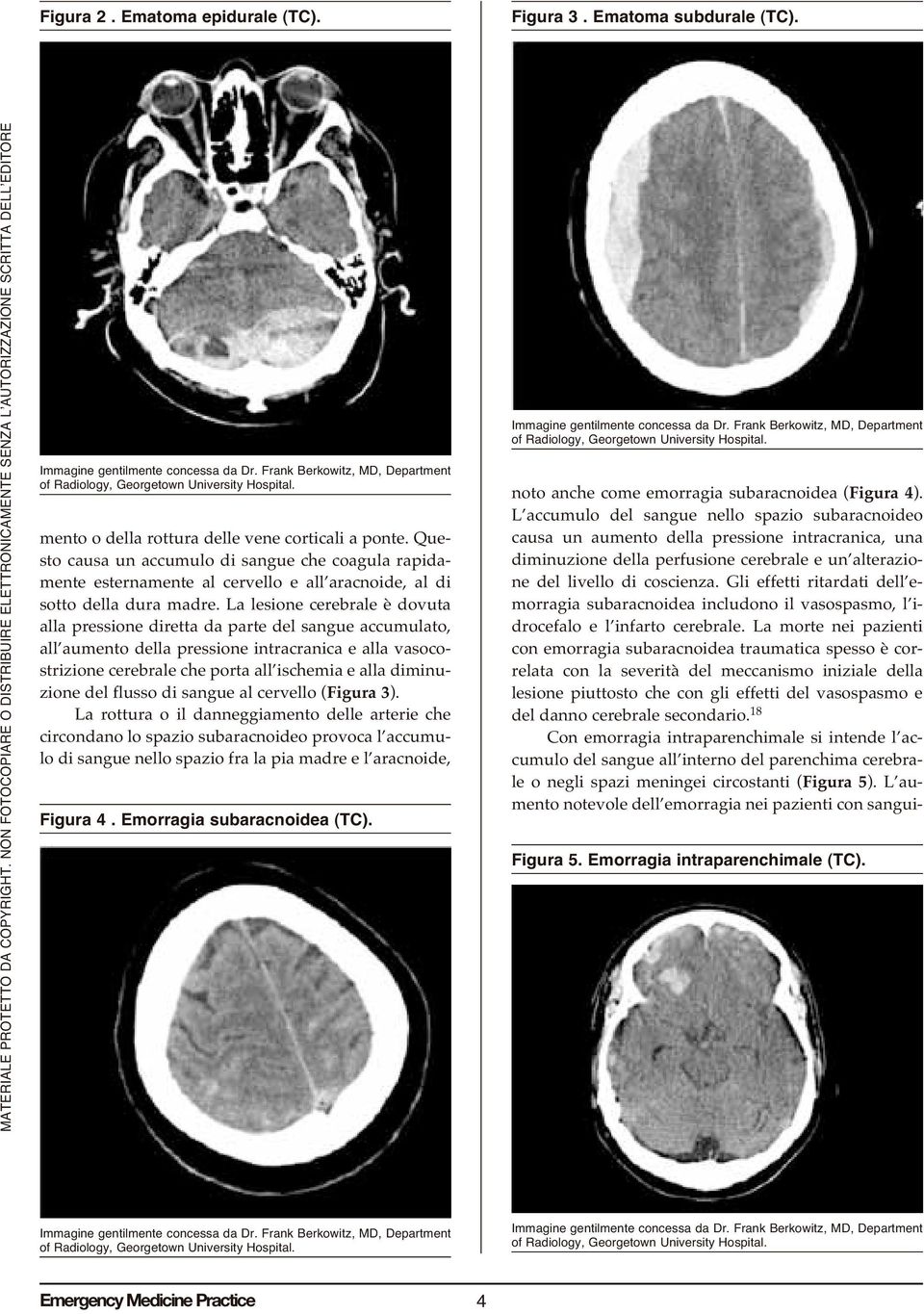 La lesione cerebrale è dovuta alla pressione diretta da parte del sangue accumulato, all aumento della pressione intracranica e alla vasocostrizione cerebrale che porta all ischemia e alla