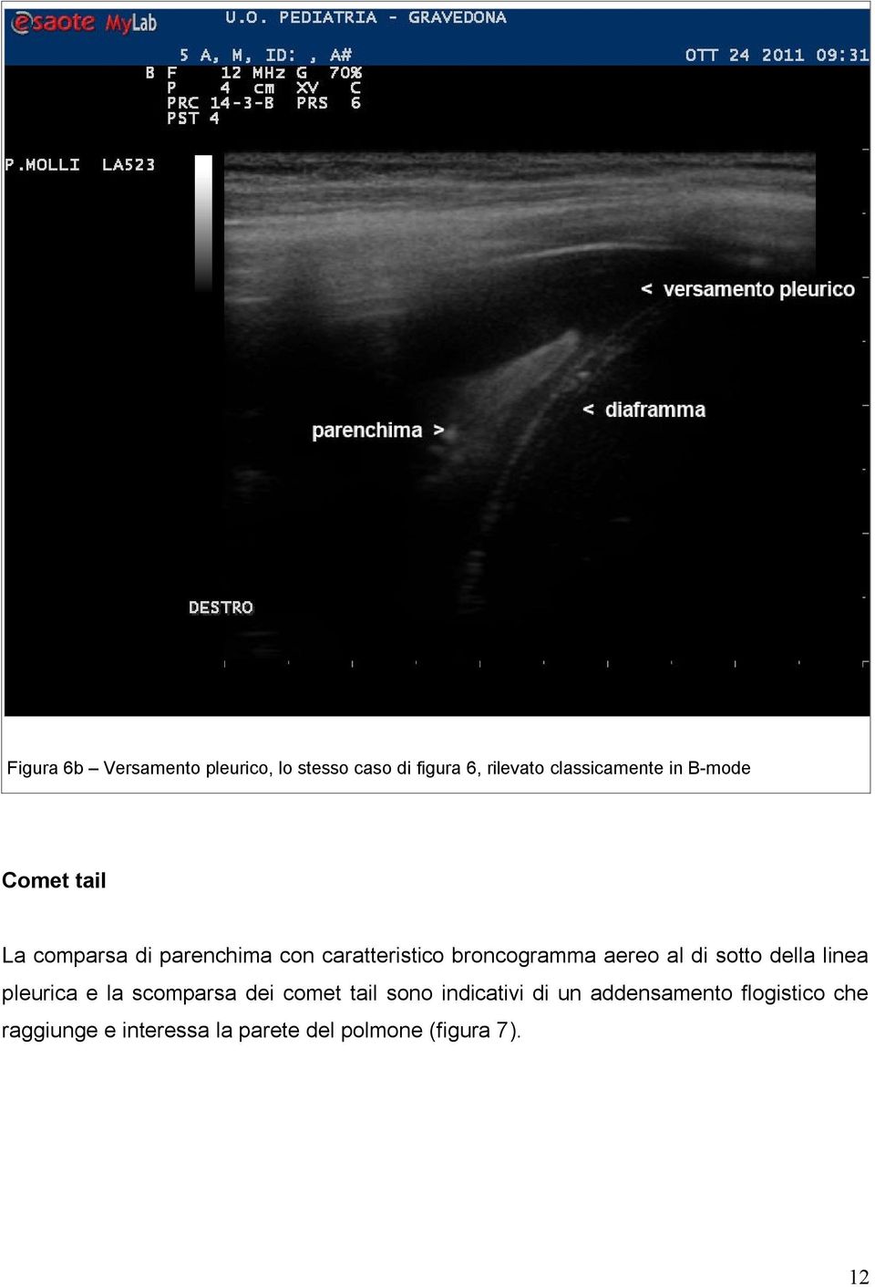 di sotto della linea pleurica e la scomparsa dei comet tail sono indicativi di un