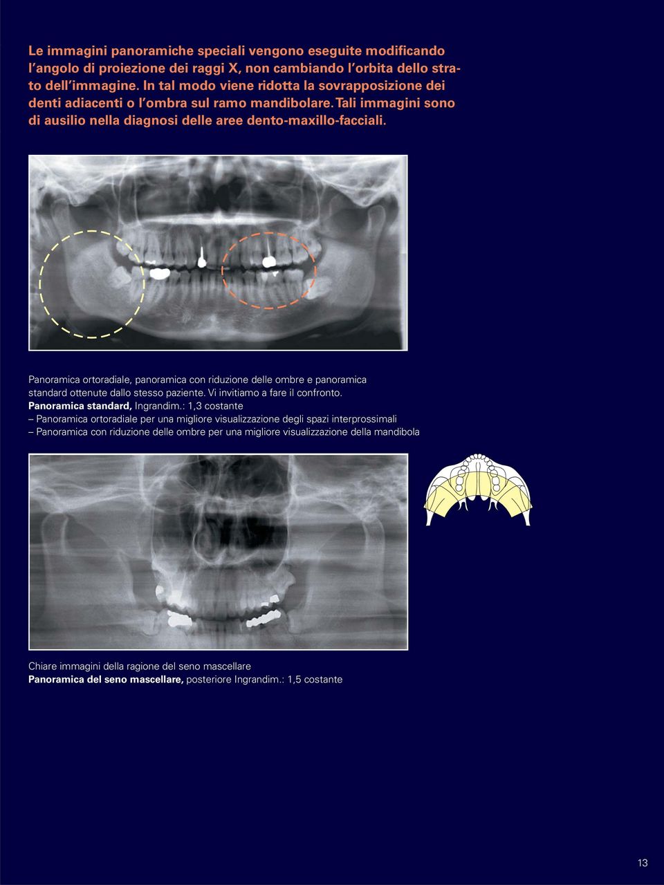 Panoramica ortoradiale, panoramica con riduzione delle ombre e panoramica standard ottenute dallo stesso paziente. Vi invitiamo a fare il confronto. Panoramica standard, Ingrandim.