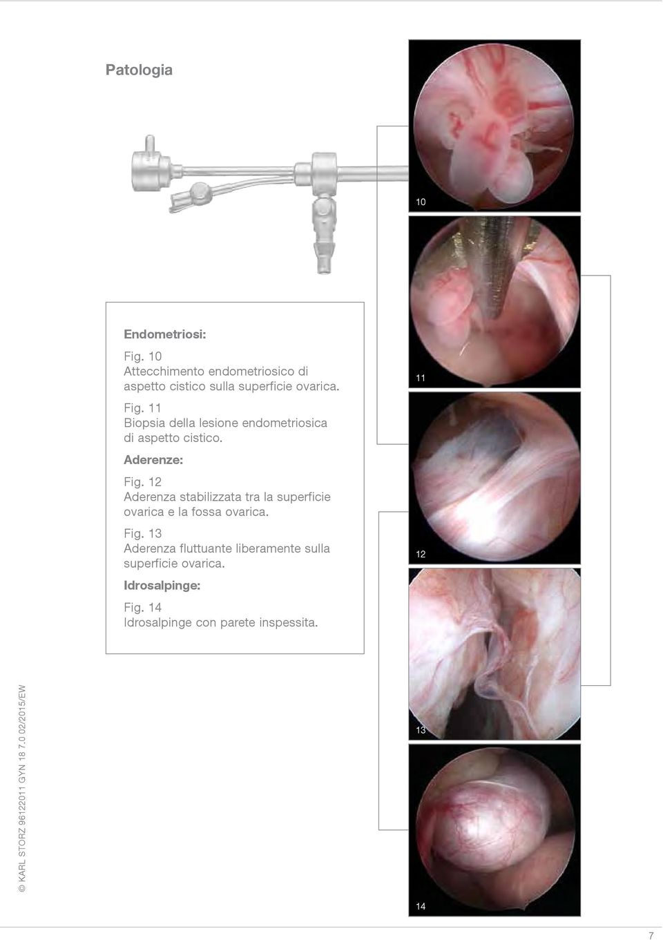 11 Biopsia della lesione endometriosica di aspetto cistico. Aderenze: Fig.