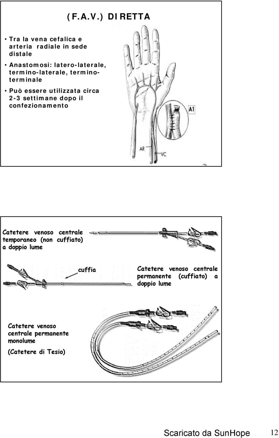 termino-laterale, terminoterminale Può essere utilizzata circa 2-3 settimane dopo il confezionamento