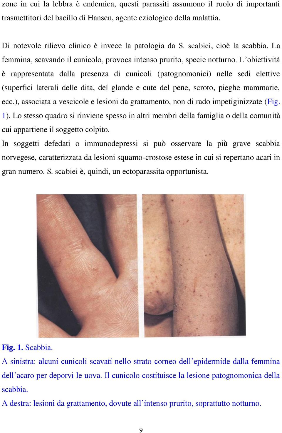 L obiettività è rappresentata dalla presenza di cunicoli (patognomonici) nelle sedi elettive (superfici laterali delle dita, del glande e cute del pene, scroto, pieghe mammarie, ecc.