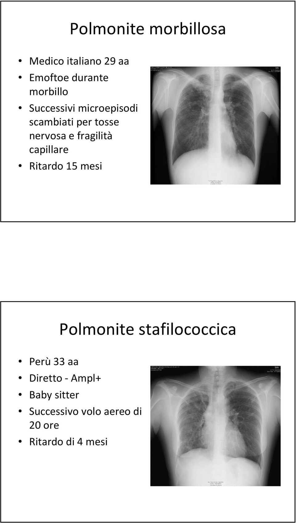 capillare Ritardo 15 mesi Polmonite stafilococcica Perù33 aa