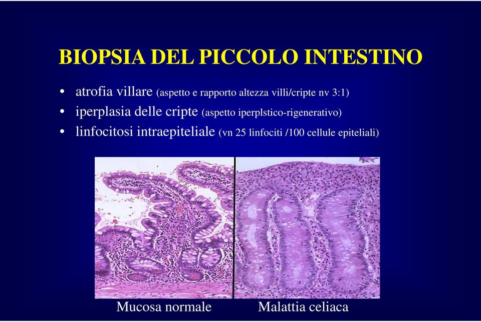 (aspetto iperplstico-rigenerativo) linfocitosi intraepiteliale