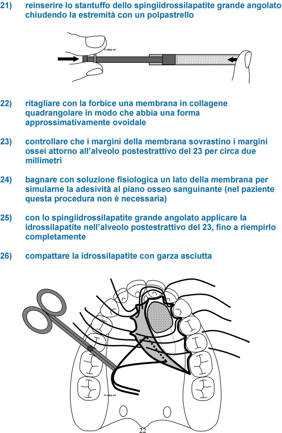 alveolo postestrattivo del 23 per circa due millimetri 24) bagnare con soluzione fisiologica un lato della membrana per simularne la adesività al piano osseo sanguinante (nel paziente questa