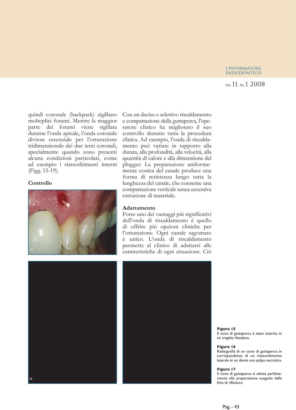 presenti alcune condizioni particolari, come ad esempio i riassorbimenti interni (Figg. 15-19).