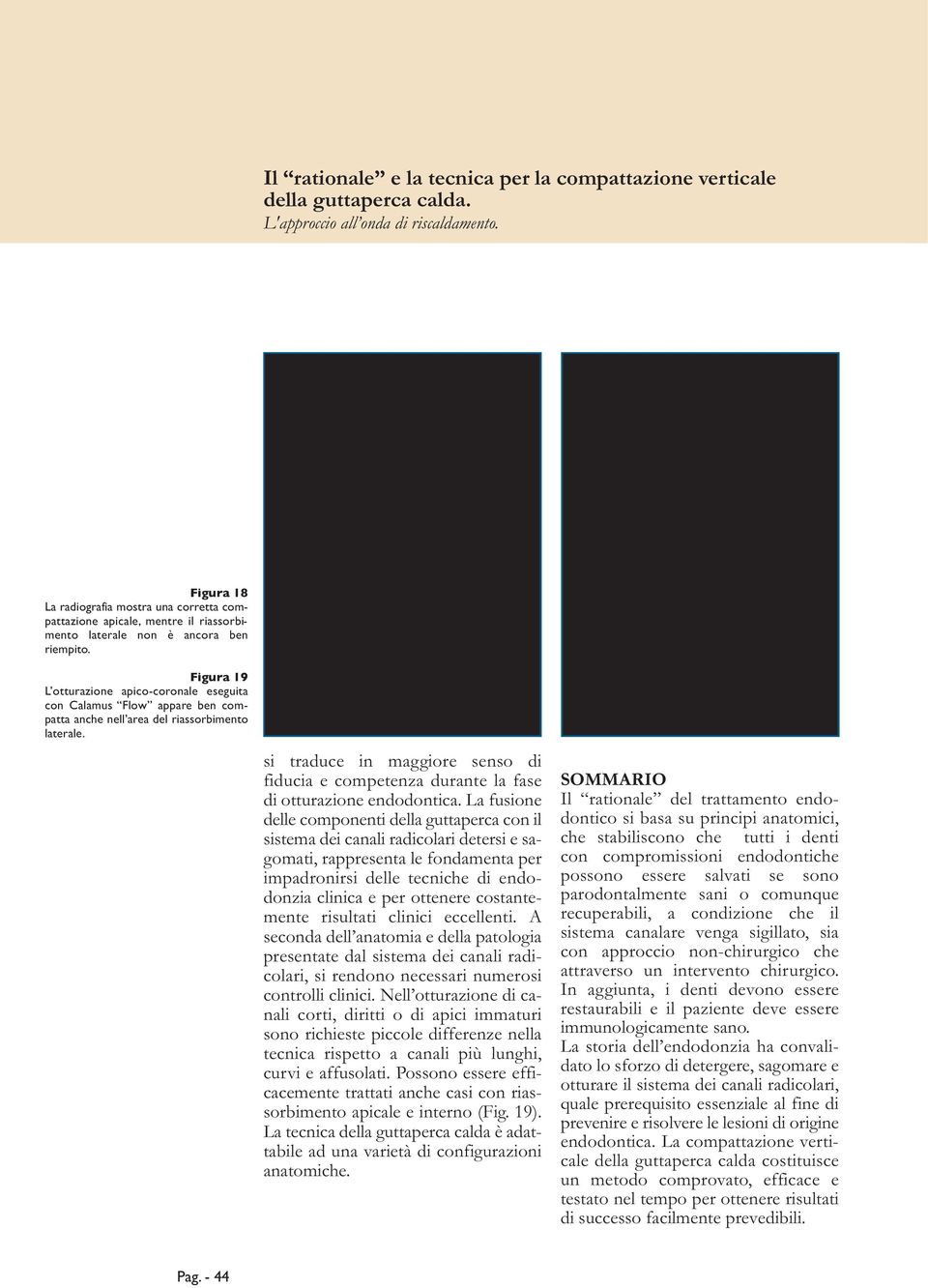 Figura 19 L otturazione apico-coronale eseguita con Calamus Flow appare ben compatta anche nell area del riassorbimento laterale.