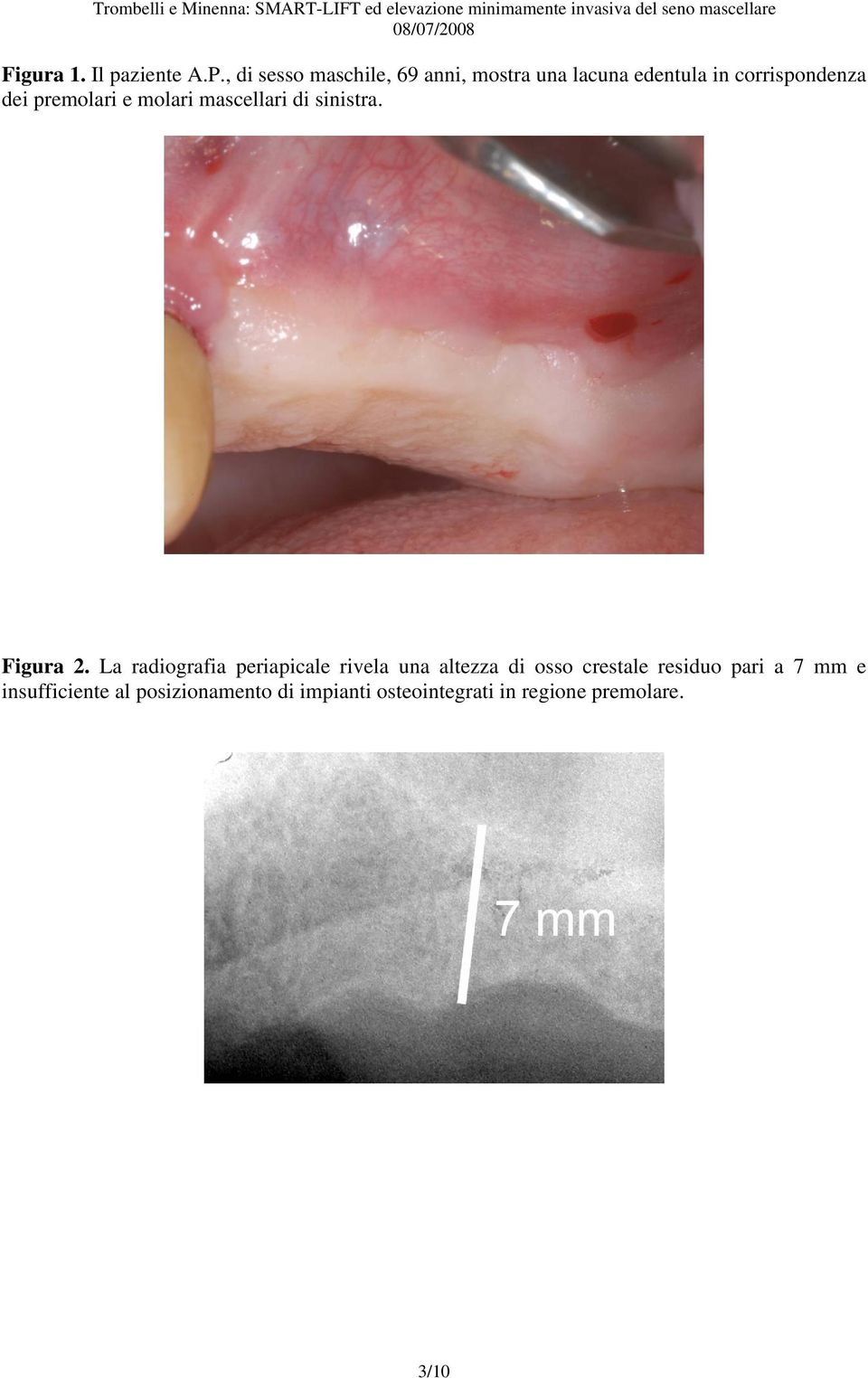 premolari e molari mascellari di sinistra. Figura 2.