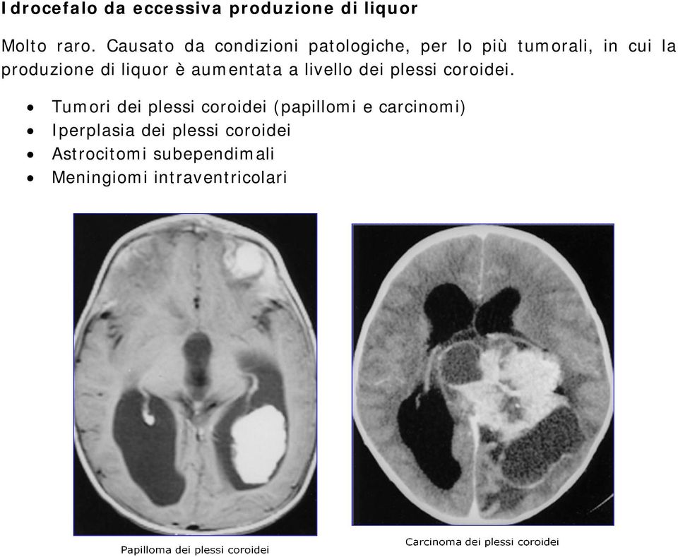 liquor è aumentata a livello dei plessi coroidei.