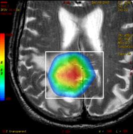 Studio RM funzionale Spettroscopia studio dei processi metabolici di tessuti ed organi in vivo NAA marker neuronale Cho