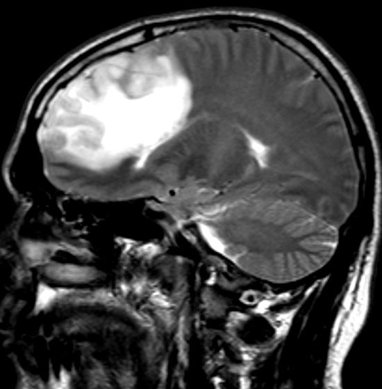 La diagnosi neuroradiologica di processo espansivo T 1 T 2 FLAIR TC 1)