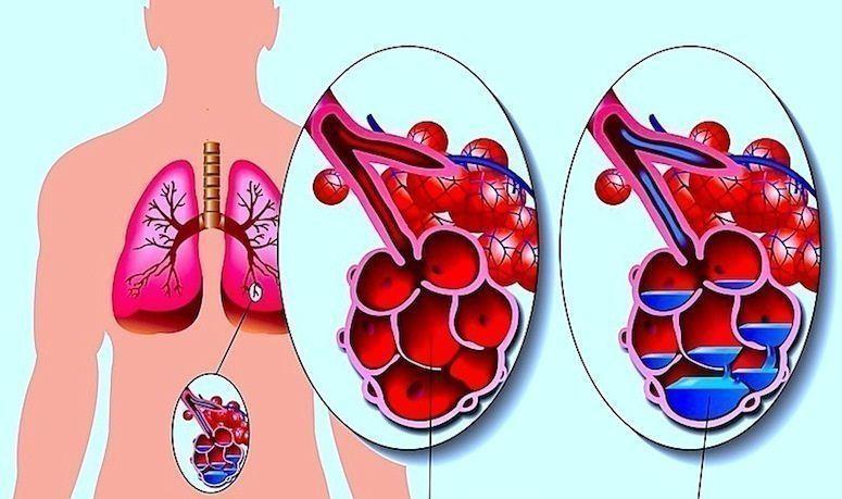 EDEMA POLMONARE ACUTO Trasudazione di