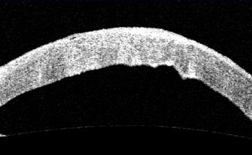 Il lato negativo della facoemulsificazione Ultrasonica DANNO BIOLOGICO Holst A, et al. Formation of free radicals during phacoemulsification. Curr Eye Res 1993 Shimmura S, et al.