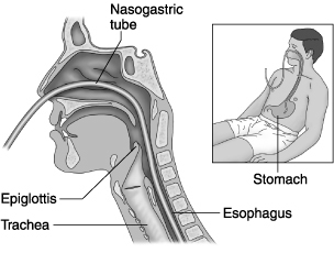 - 3 - Sonda duodenale Epiglottide Trachea Stomaco Esofago La corretta posizione della sonda viene in seguito controllata tramite una radiografia della pancia con mezzo di contrasto, con una