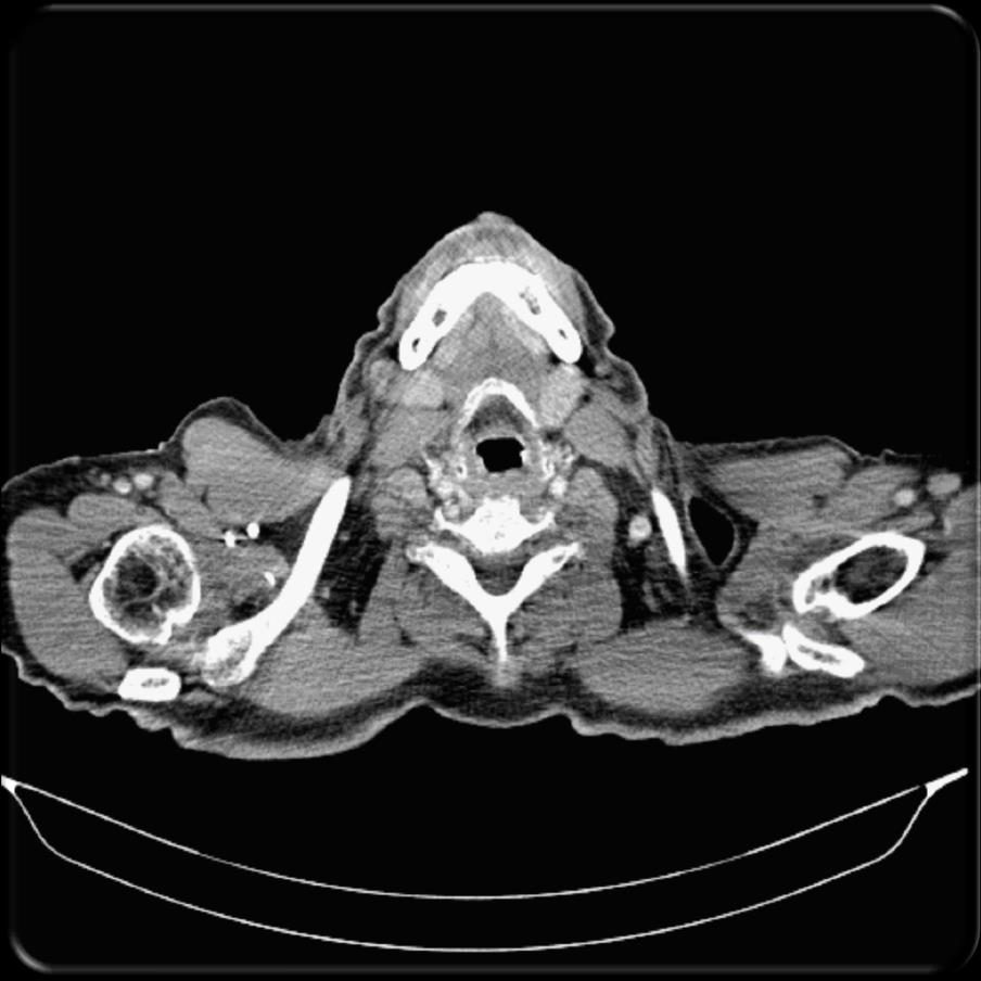 TC Presenza di laparocele mediano xifo-ombelicale di diametro cranio-caudale di 19 cm.