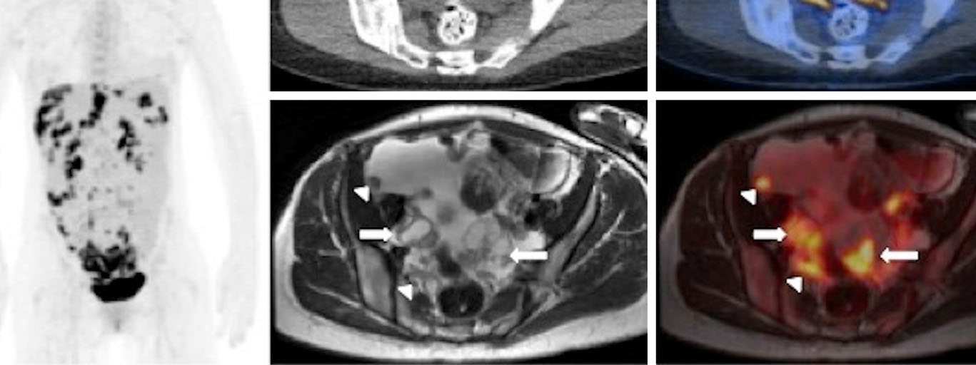 Superior delineation of the tumour in both ovaries (solid arrows) and