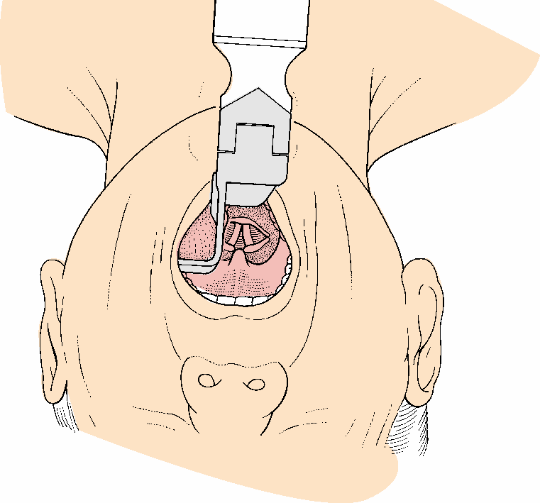 Intubazione tracheale Spostare