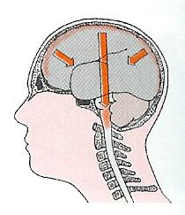 EDEMA CEREBRALE È una compressione cerebrale caratterizzata dall accumulo di liquidi negli spazi interstiziali dei tessuti encefalici con conseguente compressione ed