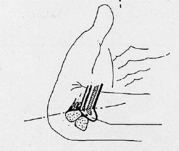 IN UN SOGGETTO SENZA PATOLOGIE DEL POLSO LA PRESSIONE ALL INTERNO DEL TUNNEL CARPALE E DI CIRCA 2.5 mm Hg QUANDO IL POLSO E MANTENUTO DIRITTO.