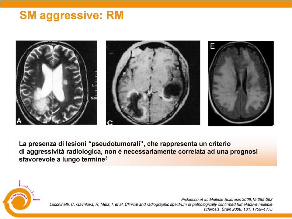 et al. Multiple Sclerosis 2009;15:285-293 Lucchinetti, C, Gavrilova, R, Metz, I, et al.