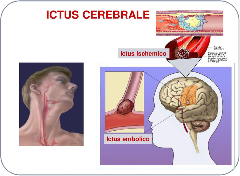 Ictus