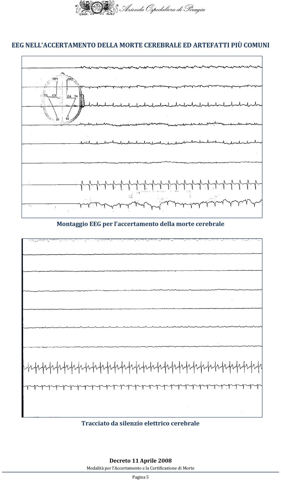 accertamento della morte cerebrale