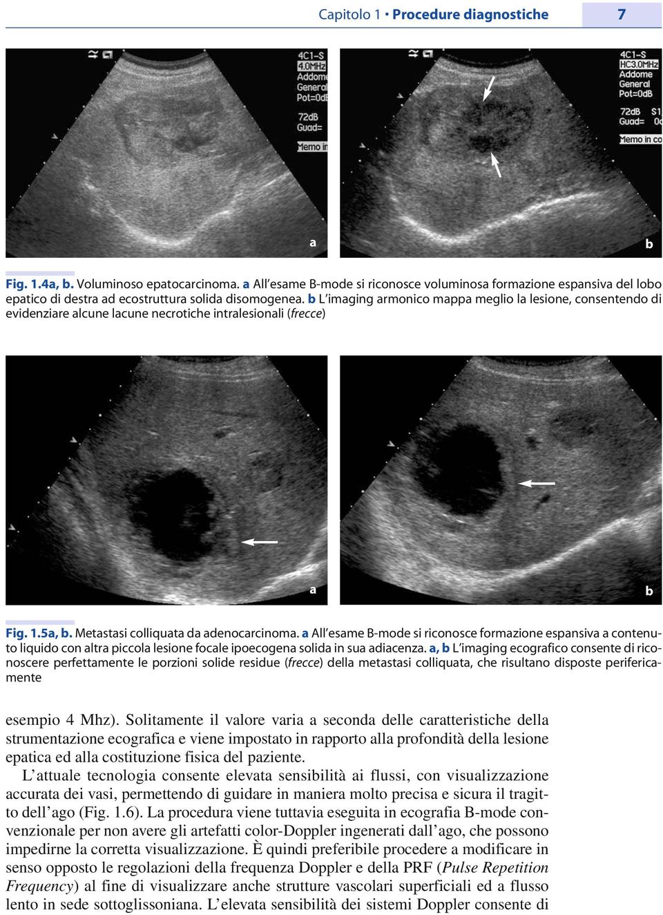 b L imaging armonico mappa meglio la lesione, consentendo di evidenziare alcune lacune necrotiche intralesionali (frecce) a b Fig. 1.5a, b. Metastasi colliquata da adenocarcinoma.