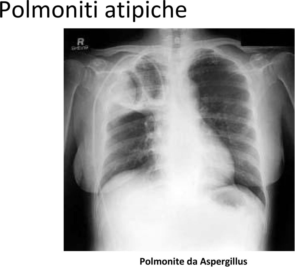 Polmonite