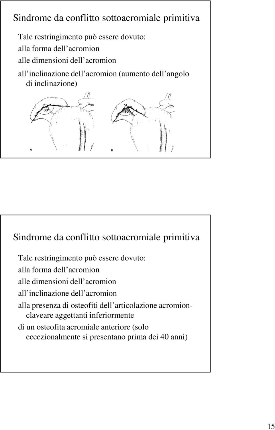 articolazione acromionclaveare aggettanti inferiormente di un osteofita acromiale anteriore (solo eccezionalmente si presentano prima dei 40